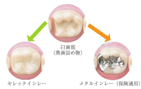 岡山市北区・筒井歯科クリニック・設計したデータを基にセラミックを加工