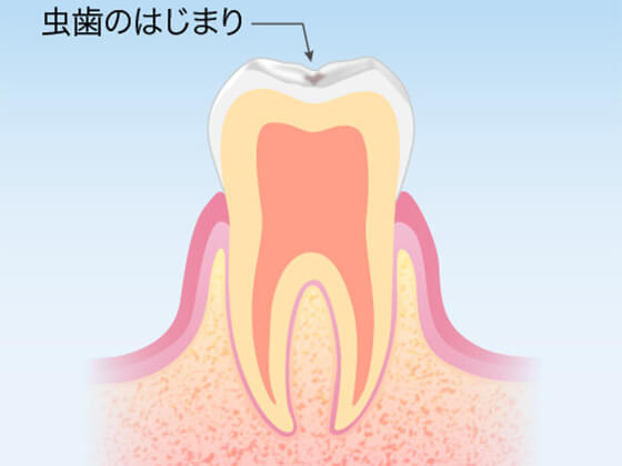 岡山市北区・筒井歯科クリニック・むし歯治療